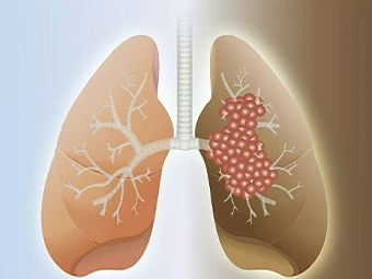 Afatinib versus Ibrutinib